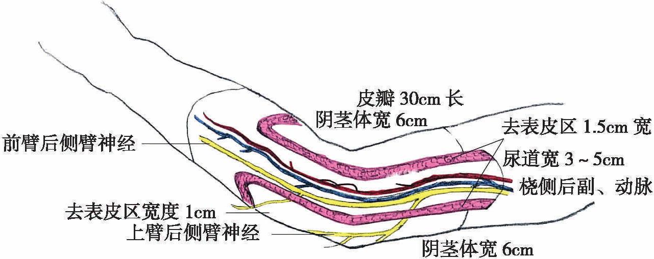 二、上臂外側(cè)皮瓣(Upton法)